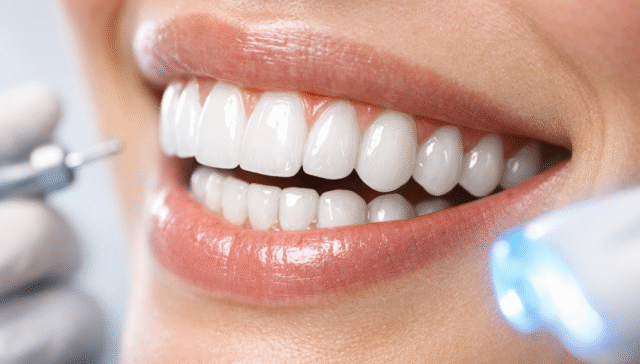 Teeth Whitening -