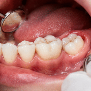 دليل شامل لعلاج جراحة ضرس العقل في 2026