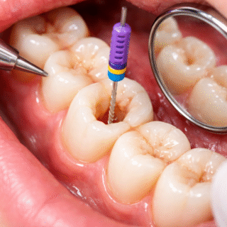 ما هو علاج قناة الجذر ومتى يحتاجه المريض؟