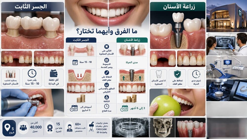 ما الفرق بين الجسر الثابت وزراعة الأسنان وأيهما تختار؟