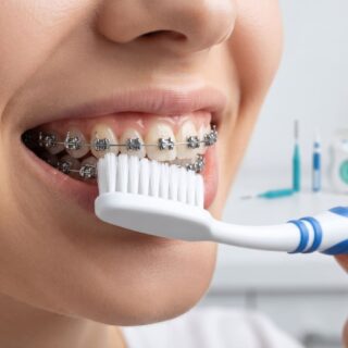 دليل تنظيف الأسنان بعد تركيب التقويم الثابت خطوة بخطوة