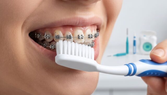 دليل تنظيف الأسنان بعد تركيب التقويم الثابت خطوة بخطوة